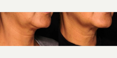 Sofwave before and after photo