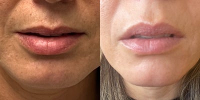 Botox before and after photo