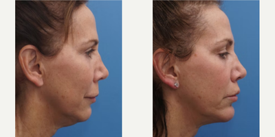 FaceTite before and after photo