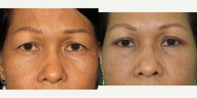 Facial Fat Transfer before and after photo
