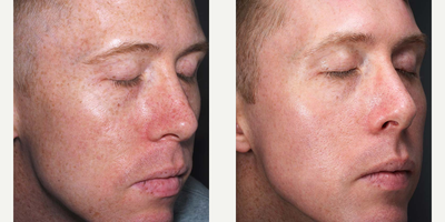 Fraxel Laser before and after photo