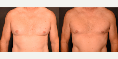 Gynecomastia Surgery before and after photo