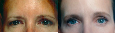 Brow Lift before and after photo