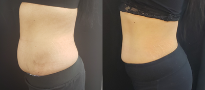 CoolSculpting before and after photo