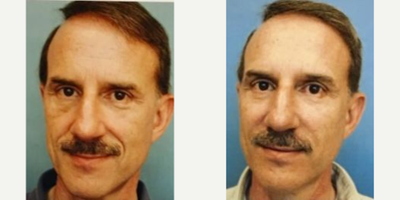 Dermal Fillers before and after photo