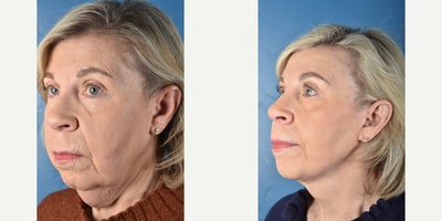 Facelift before and after photo