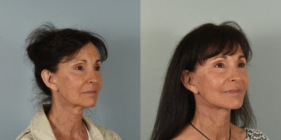 Laser Resurfacing before and after photo