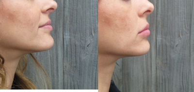 Lip Fillers before and after photo
