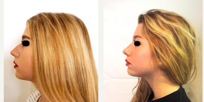 Rhinoplasty before and after photo