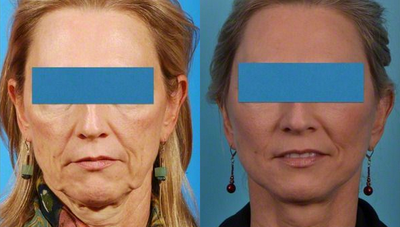 Sculptra before and after photo