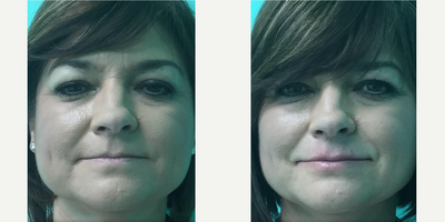 Volbella before and after photo
