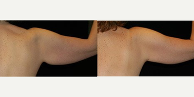 Arm Lift before and after photo