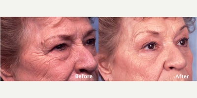 Eyelid Surgery before and after photo
