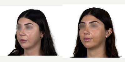 Lip Surgery before and after photo