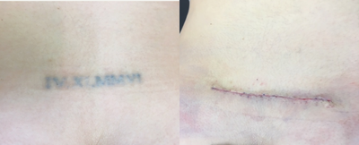Tattoo Removal before and after photo