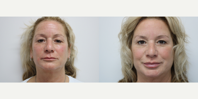 Botox before and after photo