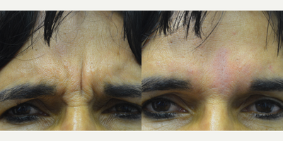 Restylane before and after photo