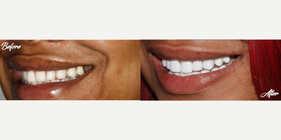 Smile Makeover before and after photo