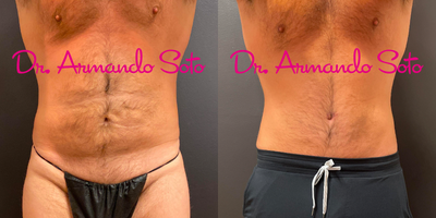 Body Lift before and after photo