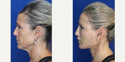 Facelift before and after photo