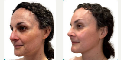 Facial Feminization Surgery before and after photo