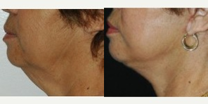 Neck Lift before and after photo