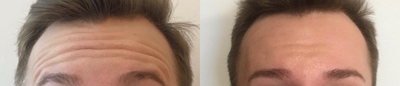 Botox before and after photo