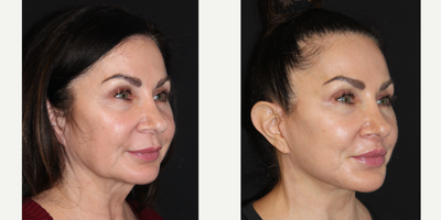 Buccal Fat Removal before and after photo