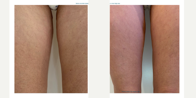Kybella before and after photo