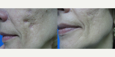 Laser Genesis before and after photo