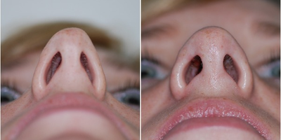 Rhinoplasty before and after photo