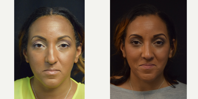 African American Rhinoplasty before and after photo