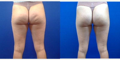 Cellfina before and after photo