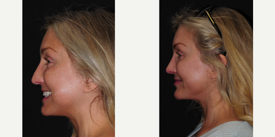 Chin Implant before and after photo