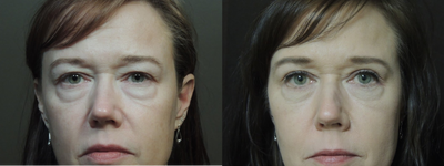 Eyelid Surgery before and after photo