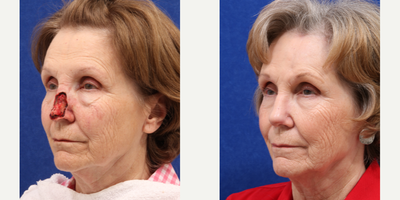 Facial Reconstructive Surgery before and after photo
