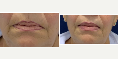 Lip Fillers before and after photo