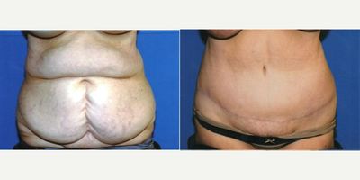 Tummy Tuck before and after photo