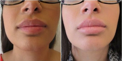 Botox before and after photo