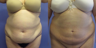 Liposuction before and after photo