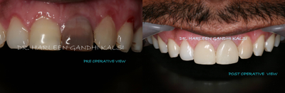 Porcelain Veneers before and after photo
