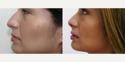 Rhinoplasty before and after photo