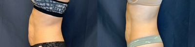 Semaglutide before and after photo