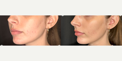 Chemical Peel before and after photo