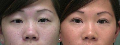 Double Eyelid Surgery before and after photo