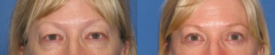 Eyelid Surgery before and after photo