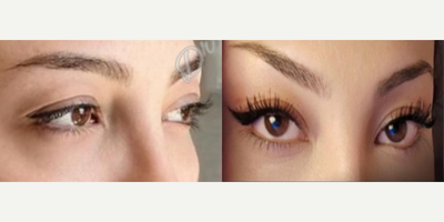Eyelid Surgery before and after photo