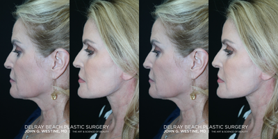Neck Lift before and after photo
