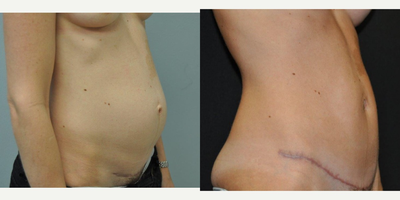 Tummy Tuck before and after photo
