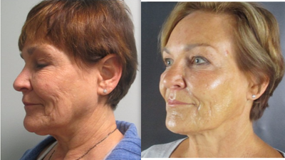 CO2 Laser before and after photo